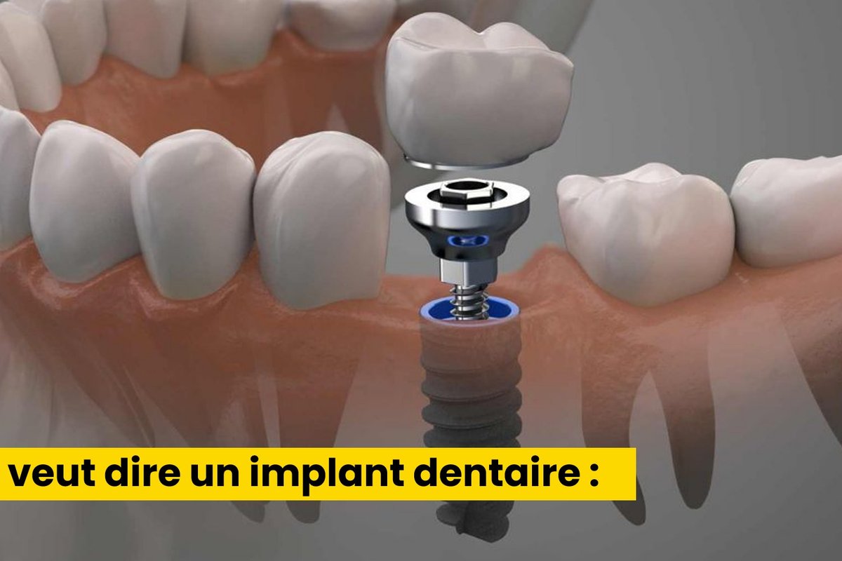 Illustration d'un implant dentaire — article du Dr Malek Omrane